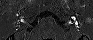 Secuencia 3D-REAL-IR axial obtenida 4h tras la administración de una dosis única de gadolinio intravenoso. Llamativa y asimétrica hiperintensidad de la cóclea y el vestíbulo izquierdos en comparación con los contralaterales, compatible con un realce perilinfático positivo izquierdo cócleo-vestibular, en un paciente con síntomas menieriformes izquierdos, traduciendo una disrupción de la barrera hematolaberíntica. Nótese que el paciente no presenta HE izquierdo, no teniendo necesariamente por qué coincidir ambos hallazgos.