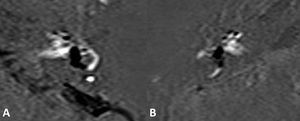 Secuencias 3D-REAL-IR de 2 pacientes distintos, obtenidas 4h después de la administración de dosis única de gadolinio. A. HE vestibular severo con herniación a la porción no ampular del canal semicircular horizontal. B. HE vestibular también marcado, en este caso con herniación a la cruz común/canal semicircular superior.