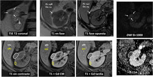 Escala de probabilidad de carcinoma renal de células claras: guía de ...