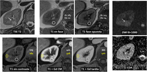 Escala de probabilidad de carcinoma renal de células claras: guía de ...