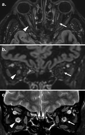 Detección de lesión del nervio óptico en una persona con esclerosis múltiple mediante secuencias 3D de doble inversión-recuperación (DIR) y T2 con saturación grasa. (a) Reconstrucciones axial y (b) coronal de una adquisición 3D-DIR que demuestran una lesión hiperintensa en el segmento canalicular del nervio óptico izquierdo (flechas). El nervio óptico derecho normal se muestra para comparación (puntas de flecha). (c) Adquisición T2 con saturación grasa al mismo nivel confirma la lesión (flecha) y muestra el nervio óptico contralateral normal (punta de flecha).