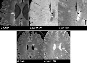 (a) Imagen FLAIR* que muestra una lesión de sustancia blanca con un signo de la vena central claramente visible (flecha). (b) SWI procesada estándar (flip angle 17°): la lesión aparece sutilmente hipointensa debido a la potenciación T1, dificultando su distinción de la sustancia blanca circundante y oscureciendo la identificación del CVS. (c) SWI procesada optimizada (flip angle 5°): la misma lesión ahora aparece hiperintensa debido al aumento de la potenciación T2*, con la vena central claramente visible. Esto ilustra por qué se recomienda la optimización del flip angle bajo o la fusión FLAIR* para una evaluación fiable del CVS. (d) otra imagen FLAIR de un paciente diferente, y (e) imágenes 3D-EPI GRE alineadas del mismo paciente que muestran claramente el CVS (flecha).