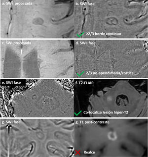 Identificación de lesiones con borde paramagnético. (a, b) SWI procesada (a) e imagen de fase (b) que muestran una lesión con borde paramagnético continuo a lo largo de más de dos tercios del perímetro, cumpliendo criterios de PRL. (c, d) Lesión periventricular en SWI (c) y fase (d) con borde continuo a través de todo el borde de la sustancia blanca; el borde ependimario (flecha) queda excluido de la evaluación según el consenso NAIMS. (e, f) Imagen de fase (e) y T2-FLAIR (f) que demuestran la colocalización necesaria del borde paramagnético con un núcleo de lesión hiperintenso en T2. (g, h) Criterio de exclusión: imagen de fase (g) muestra un borde hipointenso en una lesión con realce anular en T1 post-gadolinio (h). Las lesiones captantes deben excluirse de la clasificación PRL.