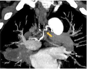 Angio-TC en fase arterial con reconstrucción MIP coronal donde se observa una arteria bronquial derecha patológica (flecha) con un diámetro >2mm, tortuosa, que alcanza el hilio pulmonar.