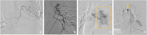 Arteriografías donde se demuestran arterias bronquiales patológicas. A) Tronco bibronquial con rama derecha hipertrofiada y tortuosa. B) Arteria bronquial izquierda tortuosa. C) Captación patológica del parénquima pulmonar (recuadro naranja). D) Aneurisma (flecha) en arteria bronquial izquierda hipertrófica y tortuosa.