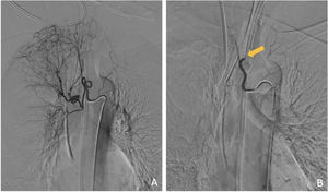 A) Arteriografía selectiva de una arteria bronquial derecha patológica. B) Arteriografía selectiva de la misma arteria bronquial derecha en la que se evidencia la oclusión arterial distal (flecha) tras embolización con microesferas de 700μm.