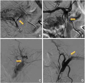 A) Arteriografía selectiva del tronco tirocervical derecho en la que se identifica opacificación de ramas de la arteria pulmonar lobar superior derecha (flecha) en relación con una fístula sistémico-pulmonar. B) Arteriografía subclavia derecha postratamiento en la que no se identifica la fístula sistémico-pulmonar. Tratamiento mediante embolización con coils (fecha). En la imagen C) se observa la arteriografía de un tronco costocervical con reflujo de contraste a la subclavia (flecha). No fue posible el cateterismo distal. D) Arteriografía subclavia izquierda en la que se evidencia oclusión del tronco costocervical con coils (flecha).