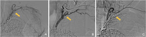 A y B) Arteriografía supraselectiva de una arteria ectópica tortuosa e hipertrófica (flecha). C) Imagen angiográfica postembolización con cianocrilato con oclusión arterial (flecha).