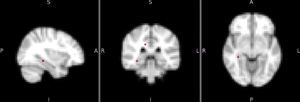 Diferencias de activación en el hipocampo derecho en Default Mode Network entre el grupo con trastorno bipolar y los controles (p=0,049).