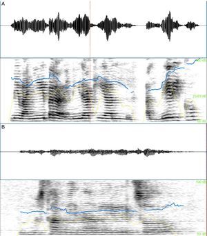 Espectrogramas comparativos de pacientes con esquizofrenia (A) y demencia frontotemporal (B). La línea azul corresponde a la melodía o curva de frecuencia fundamental y la línea amarilla, a la envolvente de amplitud.