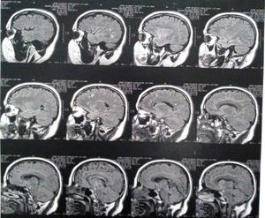 Resonancia magnética cerebral del caso a los 3 años de la primera consulta por psiquiatría.