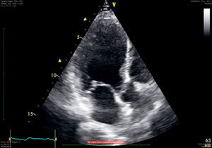 Vista de 2 cámaras; se observa «abalonamiento» ventricular por discinesia apical.