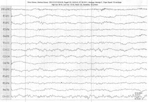 EEG paciente caso 2, con lentificación y configuración inadecuada de ritmos de fondo.