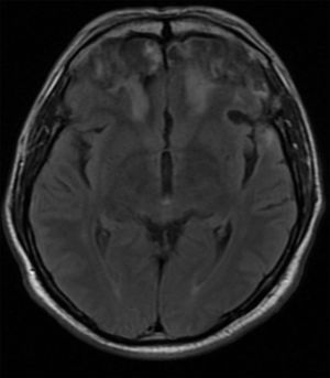 Resonancia cerebral simple que muestra áreas de encefalomalacia en los polos frontales bilaterales y la corteza orbitofrontal, así como gliosis en la sustancia blanca profunda bilateral. Secuencia FLAIR, corte axial.