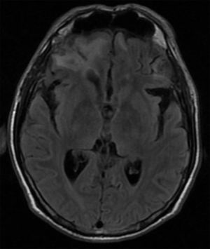 Resonancia cerebral simple que muestra zonas de contusión hemorrágica en la corteza orbitofrontal bilateral, de predominio derecho. Secuencia FLAIR, corte axial.