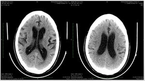 Tomografía computarizada cerebral tomada al ingreso a urgencias.