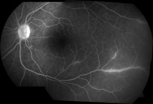 Fondo de ojo (izquierdo) con técnica de angiografía con fluoresceína en donde se observa vasculitis oclusiva.