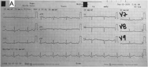 Electrocardiograma. Patrón sinusal y ondas T invertidas en V1-V2 sin signos de isquemia.