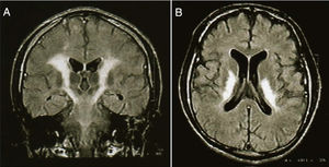 Coronal projection (A) of a magnetic resonance imaging scan in T2 sequence, of a 20-year old male with chronic inhalant abuse, which shows a selective damage of the pyramidal pathway. The axial projection (B) shows severe abnormalities of the posterior internal capsule. The patient had cuadriparesis, oral and facial apraxia, and involuntary emotional expression disorder.