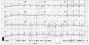 Electrocardiograma (ECG) de ritmo tomado al ingreso al servicio de urgencias.