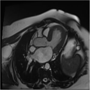 Cine en tres cámaras en fase sistólica, demostrándose un espesor normal, con ligero abombamiento del antero ápex. Ventrículo izquierdo de tamaño normal. Hay una discreta hipocinesia del segmento apical de la pared anterior, con contractilidad global y segmentaria preservada de los restantes segmentos y paredes ventriculares.