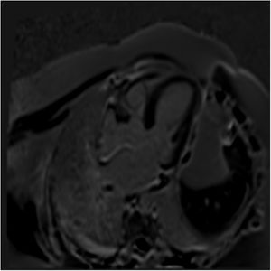 Imagen tardía post-inyección de gadolinio sin evidencia de reforzamiento tardío, ni fibrosis del miocardio. Se aprecia distribución homogénea, simétrica y sincrónica del gadolinio en todo el espesor de las paredes miocárdicas de ambos ventrículos. Viabilidad: tras la inyección del contraste no hay realces tempranos ni tardíos a nivel miocárdico que sugieran la presencia de cicatriz, fibrosis o proceso inflamatorio a nivel miocárdico o pericárdico.