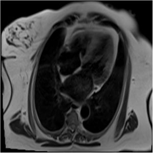 T2W en cuatro cámaras donde se observa realce del septum medio y apical y parte del segmento medio de la pared lateral, compatible con edema miocárdico. Signos de edema septal leve sin evidencia de cicatriz, fibrosis o proceso inflamatorio crónico a nivel miocárdico, compatibles con diagnóstico clínico de miocardiopatía por stress.