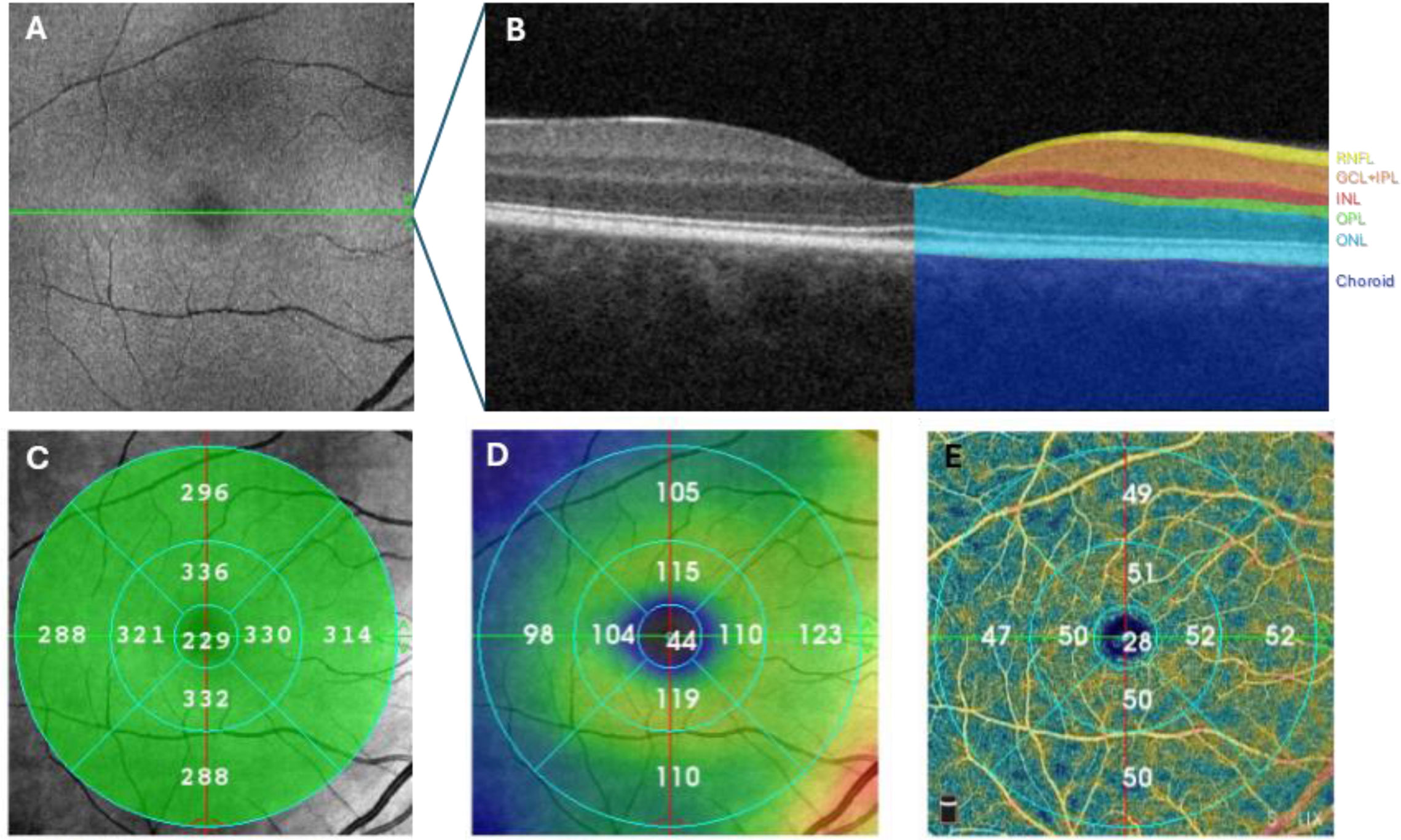 Fevea Line Retinal Neurovascular Structure in Colombian Patients With Early-Course ...