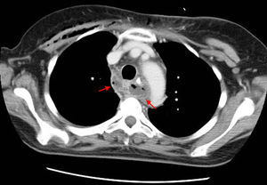 TAC torácica: colecciones paraesofágicas transversales hipodensas de 2cm de diámetro a ambos lados del esófago (lado derecho: paraesofágico alto; lado izquierdo: a nivel de la carina por delante de la aorta ascendente).