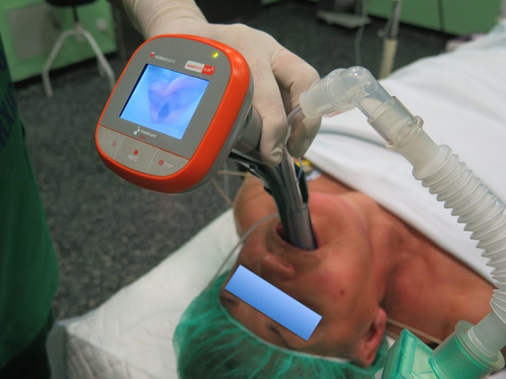 Uso del TotalTrack VLM para intubación endotraqueal urgente en vía ...
