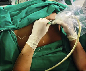 Posicionamiento del paciente y colocación del transductor de ultrasonido para bloqueo del plano del músculo erector de la columna espinal.