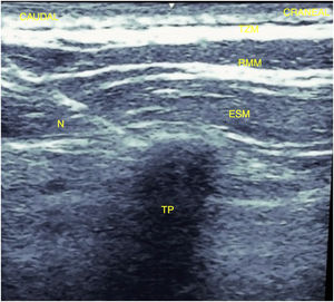 Visualización de la aguja contactando el proceso transverso T5. ESM: músculo erector de la columna espinal; N: aguja; RMM: músculo romboides mayor; TP: proceso transverso; TZM: músculo trapecio.
