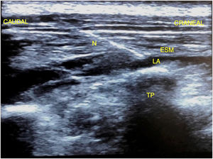 Visualización ultrasonográfica de la distribución de anestésico local bajo el músculo erector de la columna espinal. ESM: músculo erector de la columna espinal; LA: anestésico local; N: aguja; TP: proceso transverso.
