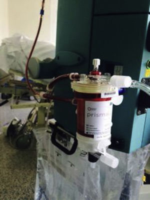 Montaje en serie del dispositivo Prismalung® en el circuito extracorpóreo de la máquina de hemodiafiltración.
