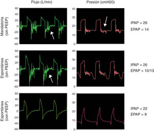 Funcionamiento de la válvula de Duc-Bill. Simulaciones con la opción 3 seleccionando una IPAP de 22 cmH2O y una EPAP de 8 cmH2O. La ventilación mandatoria (panel superior) y espontánea (panel medio) sin válvula de PEEP externa muestra un ruido en curva de flujo y presión durante la espiración (flechas). Este ruido o flutter de la válvula al espirar se asoció a un aumento en la resistencia al flujo espiratorio. Este fenómeno se revirtió al usar una válvula de PEEP externa seleccionada con el mismo valor de la EPAP aplicada (panel inferior).