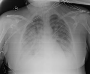 Radiografía de tórax anteroposterior en decúbito supino: empeoramiento radiológico respecto a fig. 1. Menores volúmenes pulmonares, aumento de las opacidades bibasales. Afectación radiológica moderada-grave.