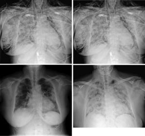 Radiografía anteroposterior de tórax, en decúbito. Extenso enfisema subcutáneo que se extiende por fosas supraclaviculares, hombros, diseca el musculo pectoral izquierdo y la mama derecha. Es importante destacar a nivel mediastínico la presencia de aire en la línea paratraqueal izquierda, que desciende rodeando el botón aórtico y en menor medida el borde cardíaco izquierdo, hallazgos compatibles con neumomediastino, no apreciándose neumotórax asociado.
