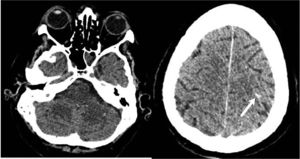 Imágenes representativas del TAC cerebral con contraste del paciente 2. En la imagen de la izquierda, el cerebelo presenta un aspecto globuloso, edematoso por probable patología hipóxico-isquémica incipiente. En la imagen de la derecha, se aprecia un posible sangrado puntiforme (flecha) en el hemisferio cerebral izquierdo.