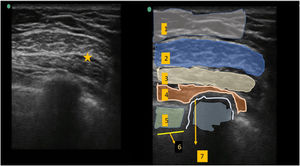 Ecografía del bloqueo Pecs II. Sitio de inyección entre el músculo pectoral mayor y el músculo pectoral menor. 1. Tejido subcutáneo. 2. Músculo pectoral mayor. 3. Músculo pectoral menor. 4. Músculo serrato anterior. 5. Músculo intercostal. 6. Pleura. 7. Costilla.