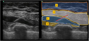 Ecografía del bloqueo Pecs II - inyección entre el músculo pectoral menor y el músculo serrato anterior. 1. Infiltración de anestésico local. 2. Tejido subcutáneo. 3. Músculo pectoral mayor y músculo pectoral menor. 4. Músculo serrato anterior.