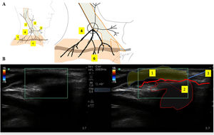 A) Figura esquemática de los nervios del plexo cervical superficial. 1. Nervio occipital menor. 2. Nervio auricular mayor. 3. Nervio cervical transverso. 4. Nervios supraclaviculares. 5. Clavícula. 6. Dermatoma de los nervios supraclaviculares. B) Ecografía del bloqueo de las ramas del nervio supraclavicular. 1. Infiltración subcutánea. 2. Sombra acústica. 3. Clavícula.