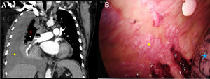 A) TC de arterias pulmonares, vista coronal donde se aprecia derrame pleural derecho (estrella amarilla) que ocasiona atelectasia compresiva del pulmón subyacente (flecha roja).B) Imagen de videotoracoscopia (VATS) donde se observa pleural parietal con implantes que forman conglomerados (estrella amarilla) y pulmón (estrella azul). El color de la figura solo puede apreciarse en la versión electrónica del artículo.