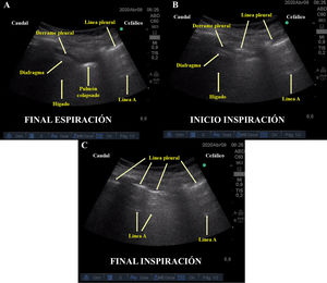 Variante del signo ecográfico hydro-point durante el ciclo respiratorio obtenida a través de sonda convexa en octavo y noveno espacio intercostal derecho con línea media axilar (plano sagital). A) Final espiración: Se observan diafragma e hígado, así como espacio anecoico entre el diafragma y la pared torácica (derrame pleural). En el espacio intercostal más cefálico se evidencian líneas «A» sin deslizamiento pleural (neumotórax). B) Inicio de inspiración: El patrón «A» observado en el extremo cefálico se empieza a desplazar caudalmente borrando todas las imágenes ecográficas subpleurales. C) Final de inspiración: Se observa solo el patrón «A» sin deslizamiento pleural en todos los espacios intercostales. Interpretamos este signo como fuga de aire del barotrauma desplazándose en sincronía con el ciclo respiratorio (Dynamic Hydro-point) (ver vídeo suplementario).