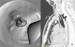 TAC cervicotorácica con reconstrucciones axiales 3D de la tráquea (A) y sagitales con ventana de pulmón (B), en las que observamos solución de continuidad de la pared posterior de la tráquea (punta de flecha en ambas imágenes) asociada a neumomediastino y a marcado enfisema subcutáneo (flechas curvas). Véase que las flechas rectas marcan el borde posterior de la cánula de traqueostomía en ambas imágenes para mejor orientación en la reconstrucción 3D.