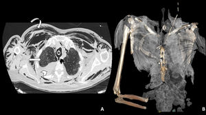 A: Imagen axial de TAC torácica con ventana de pulmón en la que se observa la rotura traqueal (cabeza de flecha negra), neumomediastino y marcado enfisema celular subcutáneo (flecha curva). En el hemitórax derecho se observa derrame pleural de alta densidad en relación con hemotórax (cabeza de flecha blanca), así como opacidades parcheadas en vidrio deslustrado en el parénquima pulmonar en relación con afectación por SARS-CoV-2 (flecha recta blanca). B: Reconstrucción 3D del enfisema subcutáneo.