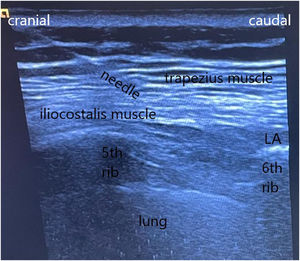Description of the parascapular sub-iliocostalis plane block performed in patient 3. With the patient in a lateral position, with both arms along the body, a high-frequency linear ultrasound probe was placed with a parasagittal orientation, immediately adjacent to the medial scapular border at the level of the edge of the sixth rib level. Identification of the lateral border of the iliocostalis muscle and performance of the parascapular sub-iliocostalis plane block. The tendinous insertion of the ILCM at the rib is in the superolateral direction (it should not be confounded with the insertion of the levatore costarum muscles whose insertion is in the inferior-lateral direction). The rhomboid major or minor muscle and the posterior superior serratus muscles are observed between the trapezius muscle and the iliocostalis muscles at upper levels. Abbreviation: LA, local anesthetic spreading.