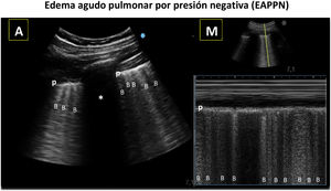 Edema agudo pulmonar por presión negativa (EAPPN) | Revista Española de ...