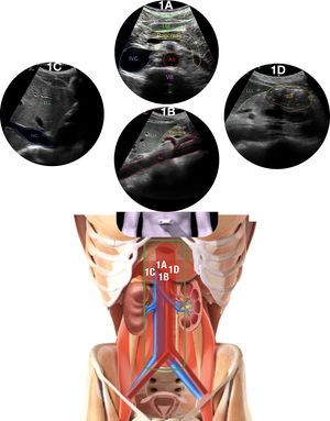 Zona central 1 del protocolo Ultrasound For Occult Haemorrhage (UFOH). Estación 1A: se observa la aorta (Ao) y la vena cava inferior (IVC; del inglés inferior vena cava) en la sección epigrástrica transversal, frente a una vértebra lumbar (VB; del inglés vertebral body) y tras el páncreas bajo el lóbulo hepático izquierdo (LLL; del inglés left lower lobe) como parte del retroperitoneo (clip 1A). Estación 1B: se observa la Ao en una sección sagital en el nivel epigástrico, con sus ramas principales (tronco celíaco [CT; del inglés celiac trunk]) y arteria mesentérica superior (SMA; del inglés superior mesenteric artery), y bajo el lóbulo hepático izquierdo (LLL) y la cabeza del páncreas en el medio (clip 1B). Estación 1C: se observa la IVC en la sección epigástrica sagital. Esta imagen se obtiene moviendo el transductor unos pocos centímetros hacia la derecha del paciente desde la estación 1B (clip 1C). Estación 1D: se observa el antro gástrico (GA; del inglés gastric antrum) en un eje circular corto, muy próximo al LLL, en la sección epigástrica sagital moviendo el transductor hacia la izquierda del paciente desde la estación 1A (clip 1D).