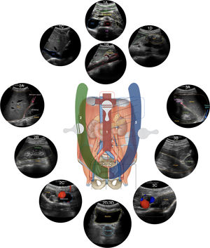 Vista resumida de todas las estaciones del protocolo Ultrasound For Occult Haemorrhage (UFOH). En rojo, la arteria iliaca. En azul, la vena iliaca. Ao: aorta, SMA: arteria mesentérica superior, del inglés mesenteric superior artery, LLL: lóbulo hepático izquierdo, del ingles Left liver lobe, IVC: vena cava inferior, del inglés inferior vena cava, VB: cuerpo vertebral, del inglés vertebral body, RLL: lóbulo hepático derecho, del inglés right liver lobe, GA: antro gástrico; del ingles Gastric antrum, R-Kidney: riñón derecho, del inglés right kidney, L-Kidney: riñonera izquierdo del inglés left kidney.