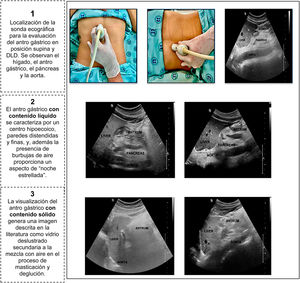 Visualización del antro gástrico mediante ecografía gástrica, con diferentes contenidos gástricos. DLD: decúbito lateral derecho.